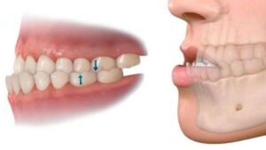 Chỉnh lệch hàm nên niềng răng hay phẫu thuật? 3 tiêu chí chọn đúng phương pháp