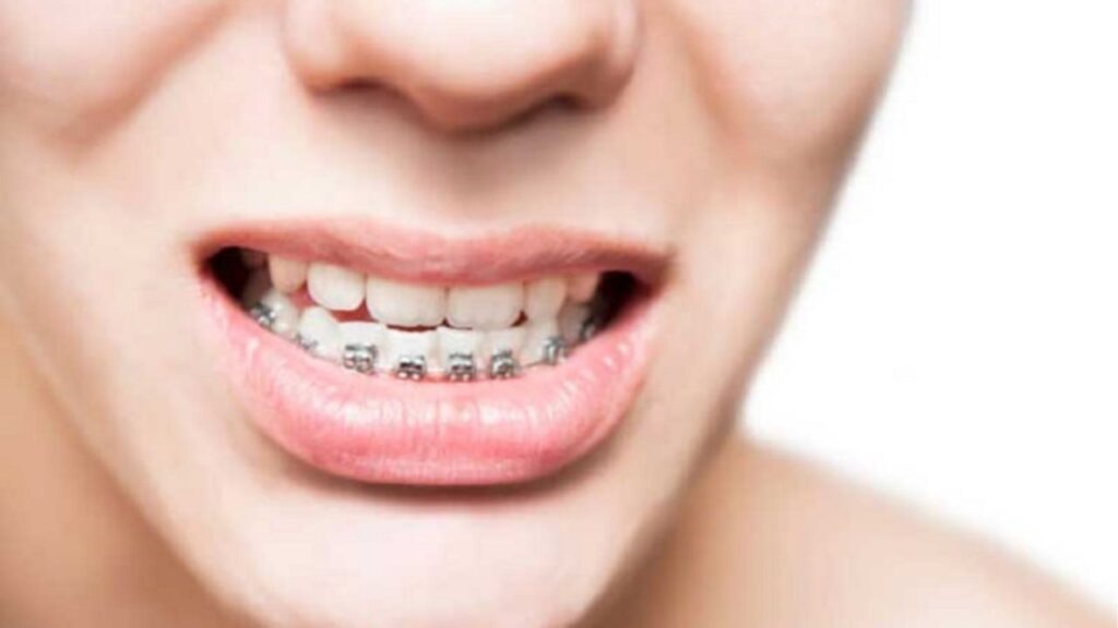 Chỉnh hàm móm có cần niềng trước không? 3 điều quan trọng cần biết