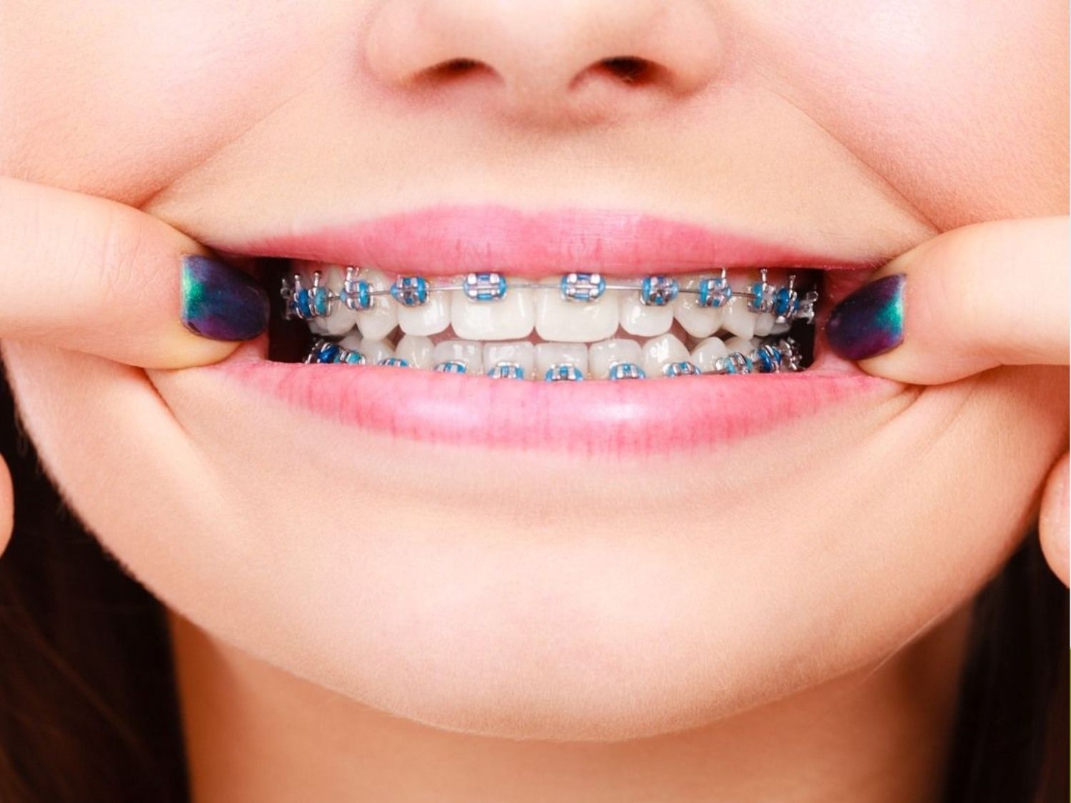 chỉnh hàm móm cần niềng trước