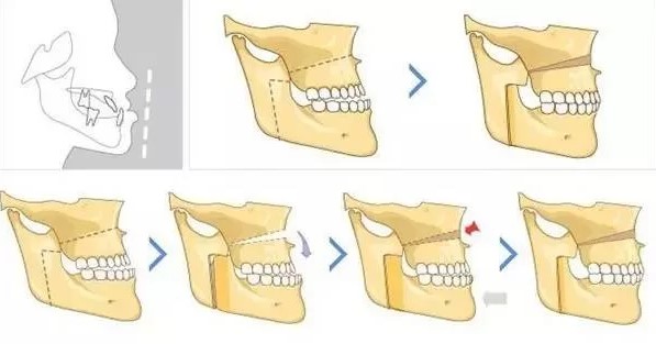 Kỹ thuật phẫu thuật BSSO điều trị móm và lệch xương hàm