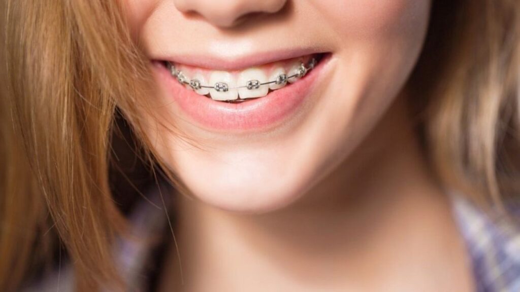 Chỉnh hàm mặt khác gì niềng răng? Phân biệt để tránh điều trị sai