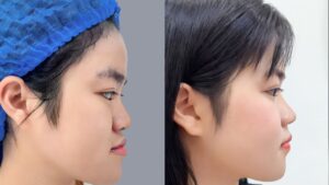 Chỉnh hàm móm là gì? Cách điều trị khớp cắn ngược hiệu quả