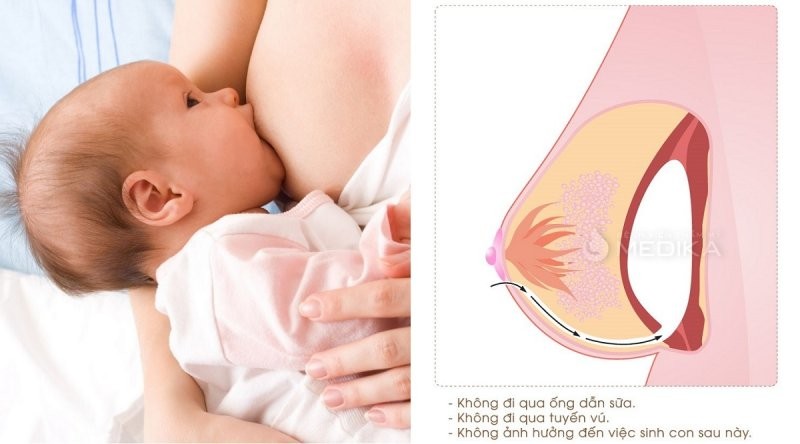 Sau khi nâng ngực tuyến sữa không bị ảnh hưởng và vẫn có thể cho con bé