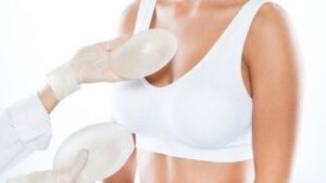 Giải mã cơ chế nâng ngực 2026: Tại sao đặt túi dưới cơ giúp ngực bền đẹp và an toàn hơn