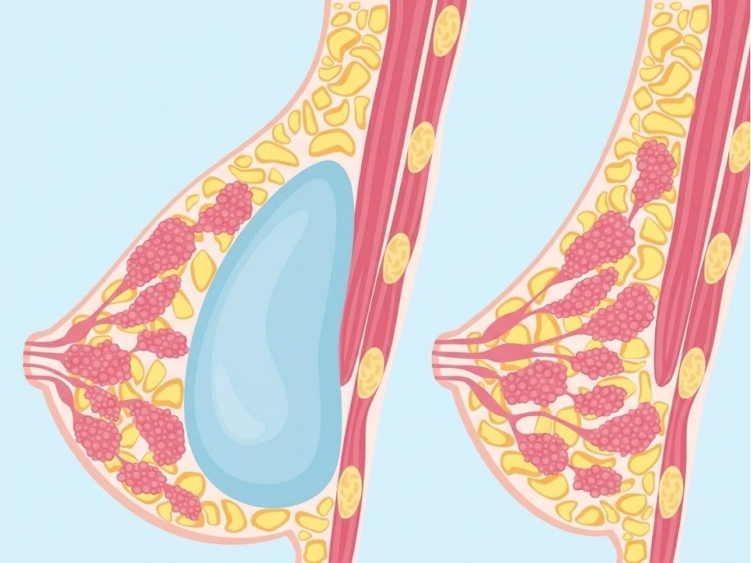 Cơ chế của phương pháp nâng ngực bằng túi độn là sử dụng túi độn silicone hoặc túi nước biển để tăng thể tích bầu ngực, ảnh minh họa