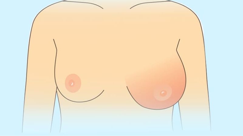 Biến chứng lệch túi và ngực không cân đối do không mặc áo định hình đúng cách