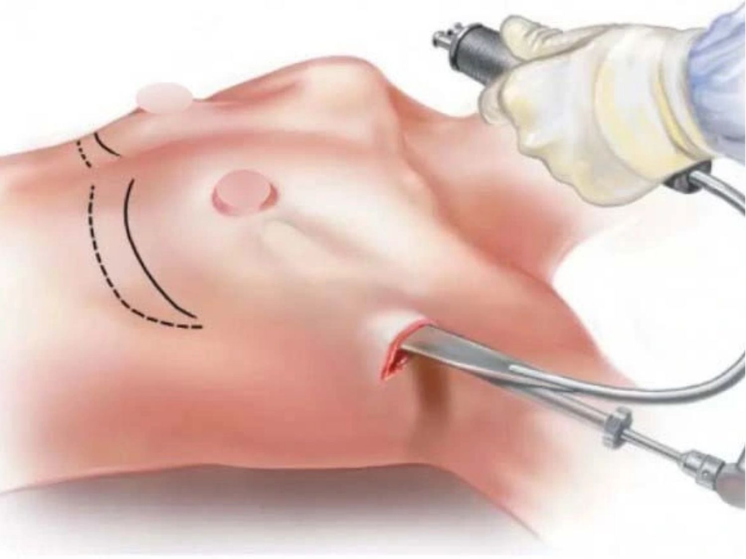 Nâng ngực nội soi đưa túi độn vào bên trong khoang ngực thông qua sự hỗ trợ của thiết bị nội soi chuyên dụng