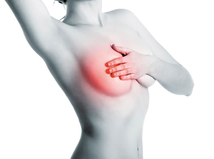 Hình ảnh minh họa ngực khách hàng bị sưng lệch một bên, căng bóng do tích tụ dịch seroma sau nâng ngực 10 ngày.