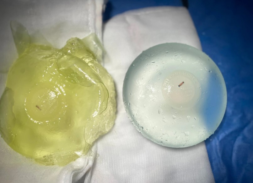 Trường hợp túi ngực bị bao xơ cần tháo bỏ