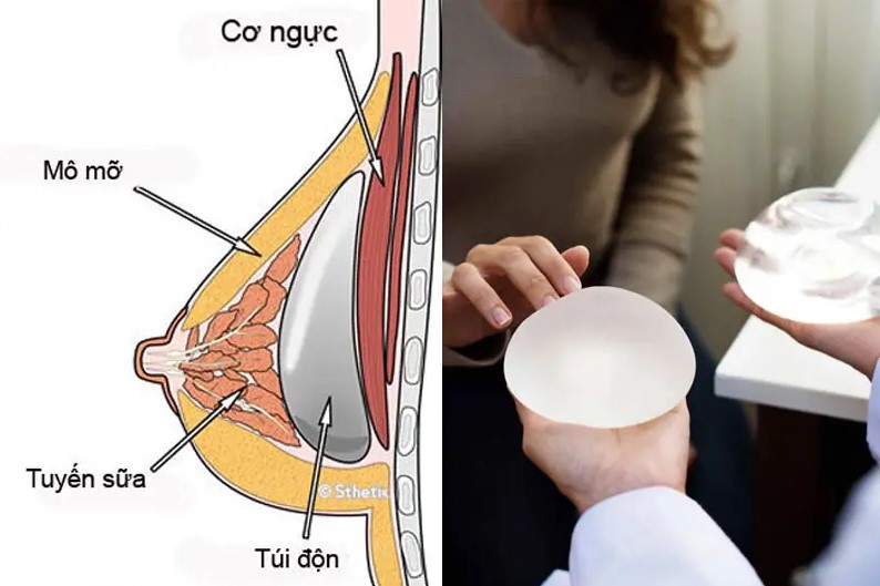Kỹ thuật đặt túi ngực dưới cơ giúp bảo vệ bao xơ và toàn nội tạng