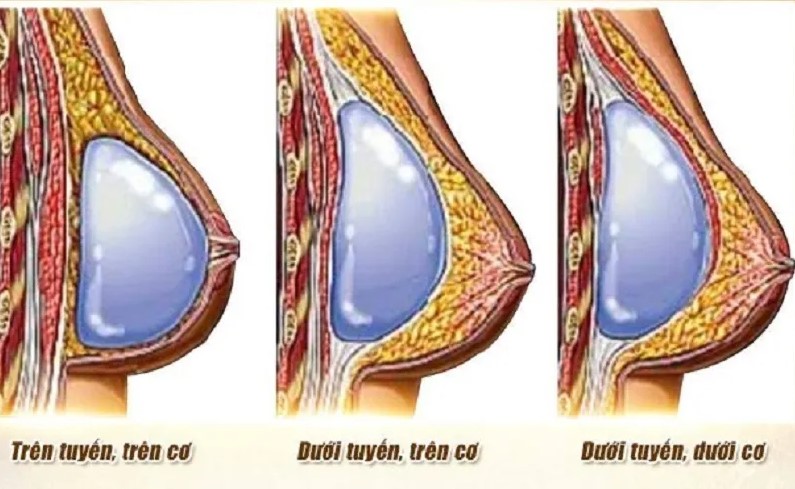 Các vị trí đặt túi ngực được áp dụng