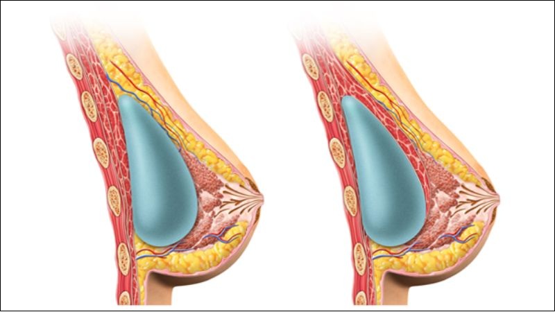Kỹ thuật đặt túi dưới cơ (Dual Plane) giúp cách ly hoàn toàn túi độn với tuyến sữa.
