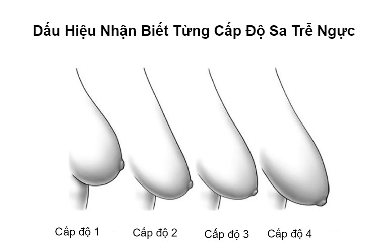 Hình ảnh minh họa các cấp độ sa trễ ngực ở phụ nữ sau sinh và phương pháp khắc phục]