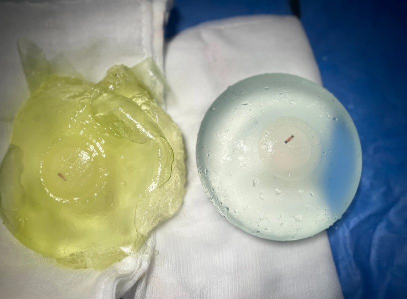 Tình trạng túi ngực bị co thắt bao xơ cần phải tháo