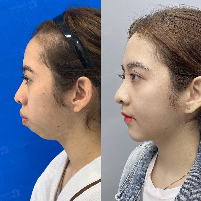 Trường hợp cằm ngắn được chỉ định độn cằm để làm khuôn mặt cân đối hơn