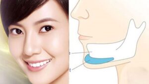 Độn cằm là gì? Lộ trình kiến tạo cằm V-line tỉ lệ vàng và so sánh các chất liệu độn