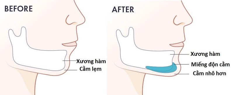 Khoang đặt sụn phải được bóc tách vừa khít để tránh tình trạng sụn "trôi" tự do.