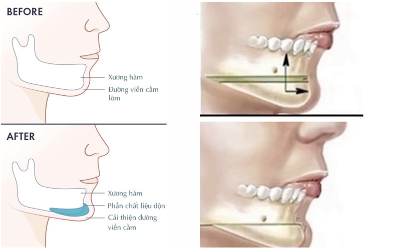 So sánh vị trí can thiệp xuống khi gọt hàm vline và trượt cằm