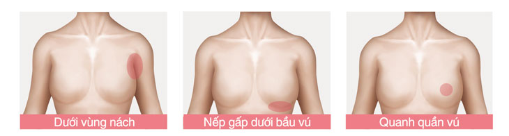 Sơ đồ minh họa vị trí đường mổ nâng ngực: đường nách nội soi, đường chân ngực và đường quầng vú tại Bệnh viện Thẩm mỹ Kangnam.