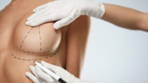 Đường mổ nâng ngực nào đẹp nhất? So sánh các đường nách, chân ngực và quầng vú