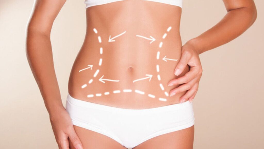 Bảng giá hút mỡ toàn thân 2026:Tổng hợp chi phí trọn gói và ưu đãi combo nhiều vùng 2026