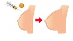 Giá nâng ngực bằng mỡ tự thân bao nhiêu? Bảng giá Bio Fat 2026