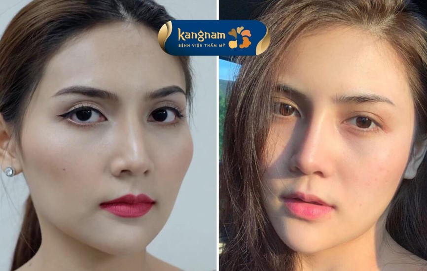 Kết quả hạ gò má không gây hóp má cho khách hàng