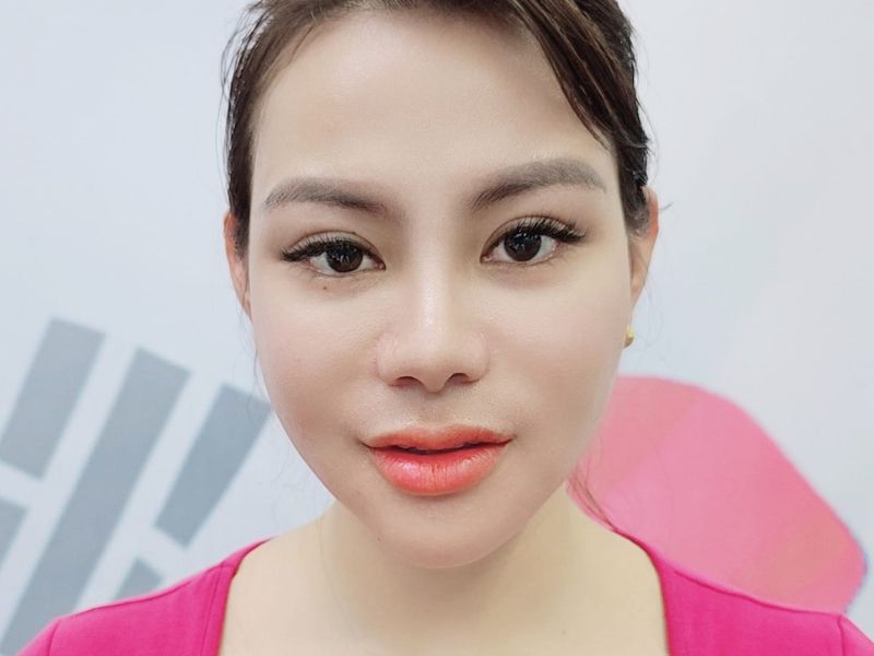 Sự thay đổi diện mạo ngoạn mục của khách hàng 32 tuổi sau khi phẫu thuật chỉnh hàm mặt.