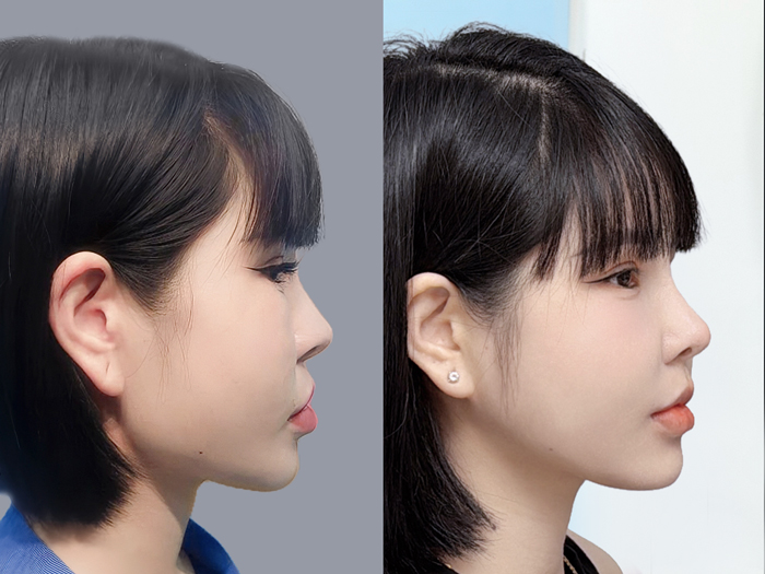 Khách hàng sở hữu gương mặt thon gọn, cân đối sau gọt hàm