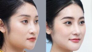 Gọt hàm có đau không? Review cảm giác 48h đầu từ bác sĩ