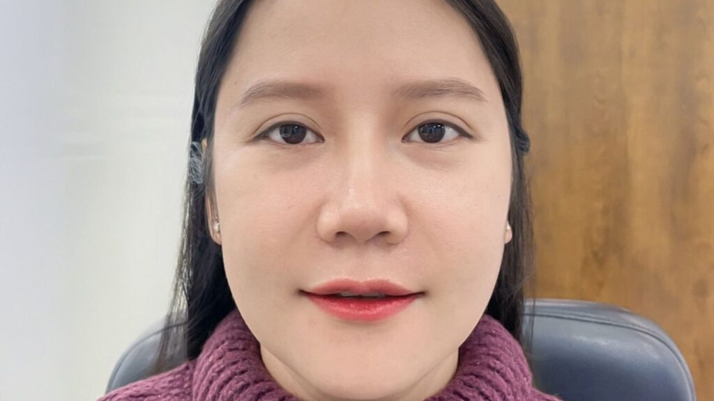 Gọt hàm có làm gò má thấp xuống không? Giải đáp từ chuyên gia