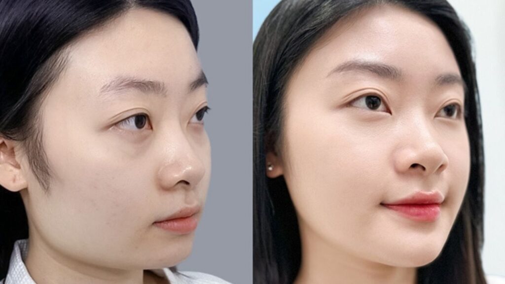 Gọt hàm có nguy hiểm không? 5 biến chứng thường gặp và phác đồ an toàn chuẩn y khoa