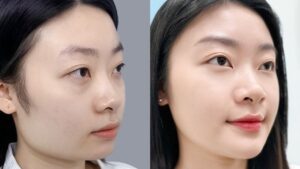 Gọt hàm có nguy hiểm không? 5 biến chứng thường gặp và phác đồ an toàn chuẩn y khoa