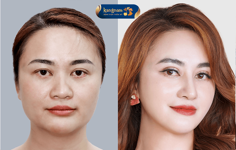 Gọt hàm chỉ loại bỏ phần xương thô bè, gương mặt vẫn giữ được các nét riêng