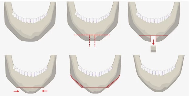 Mô phỏng kỹ thuật gọt hàm thực hiện cắt bỏ phần xương góc hàm bạnh để tạo hình đường viền hàm thon gọn.