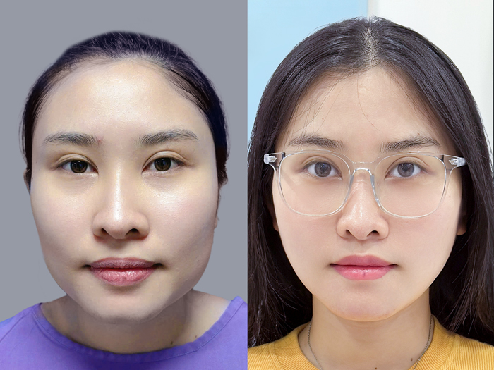 Cấu trúc xương hàm mặt sau phẫu thuật gọt hàm giúp khuôn mặt thon gọn nhưng vẫn giữ nét riêng cá nhân.