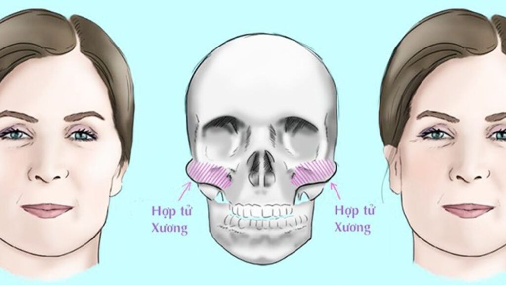 Gọt hàm và hạ gò má khác nhau thế nào? Phân biệt vùng tác động và hiệu quả thẩm mỹ