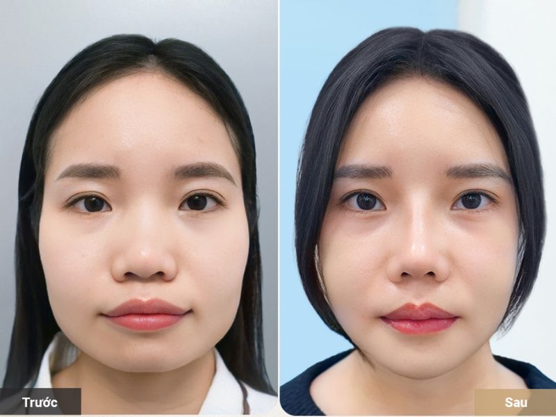 Xương hàm to bạnh có thể gọt hàm để tạo khuôn mặt thanh thoát