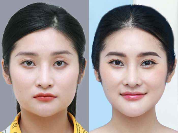 ảnh khách trước và sau gọt hàm