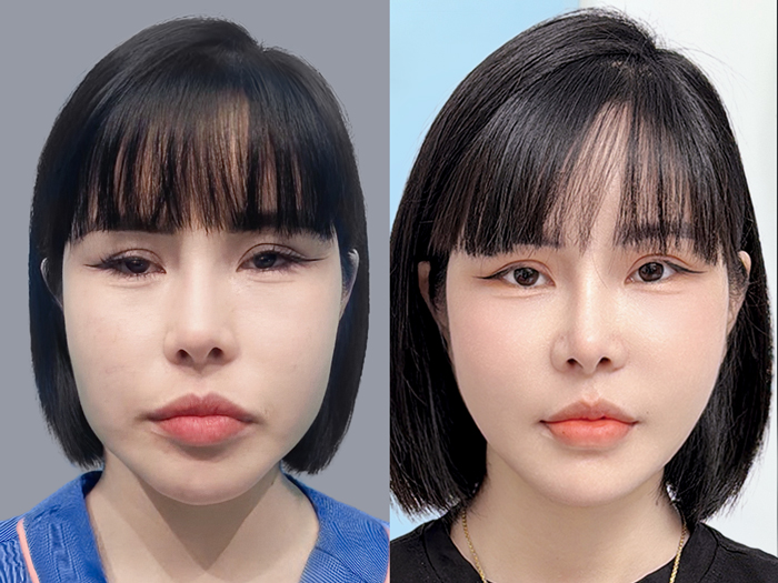 Khách sau gọt hàm tại Kangnam 1 tháng đã ổn định