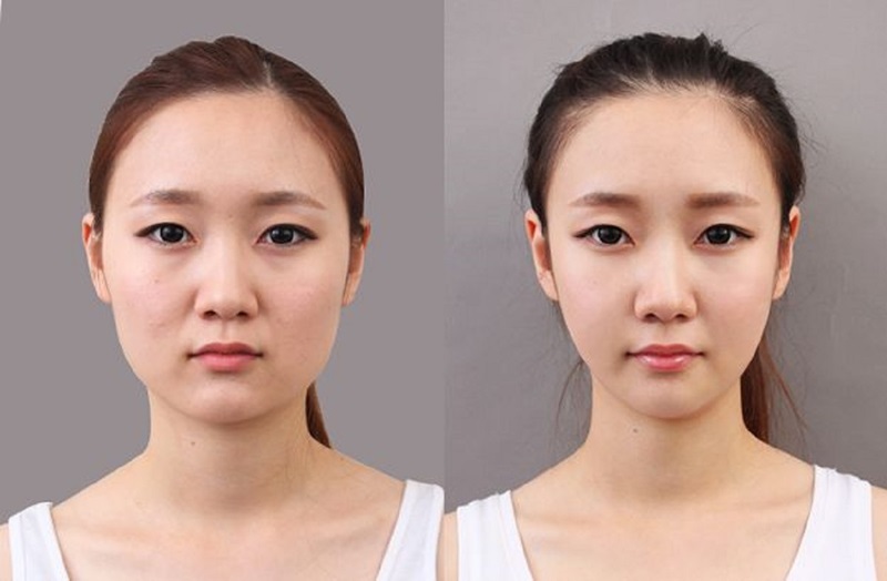 Mô phỏng gương mặt sau hạ gò má giúp gương mặt thon gọn