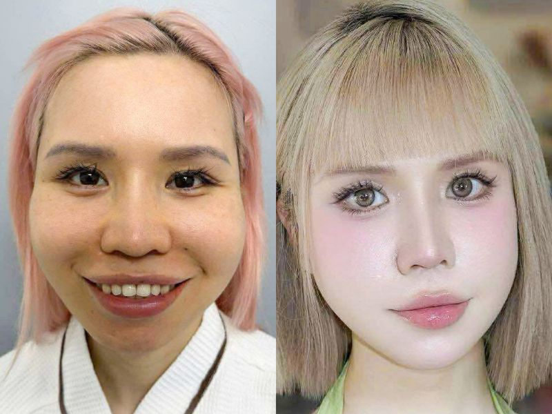 Vị trí xương hàm dưới và xương gò má là hai điểm mấu chốt quyết định chiều ngang của khuôn mặt.