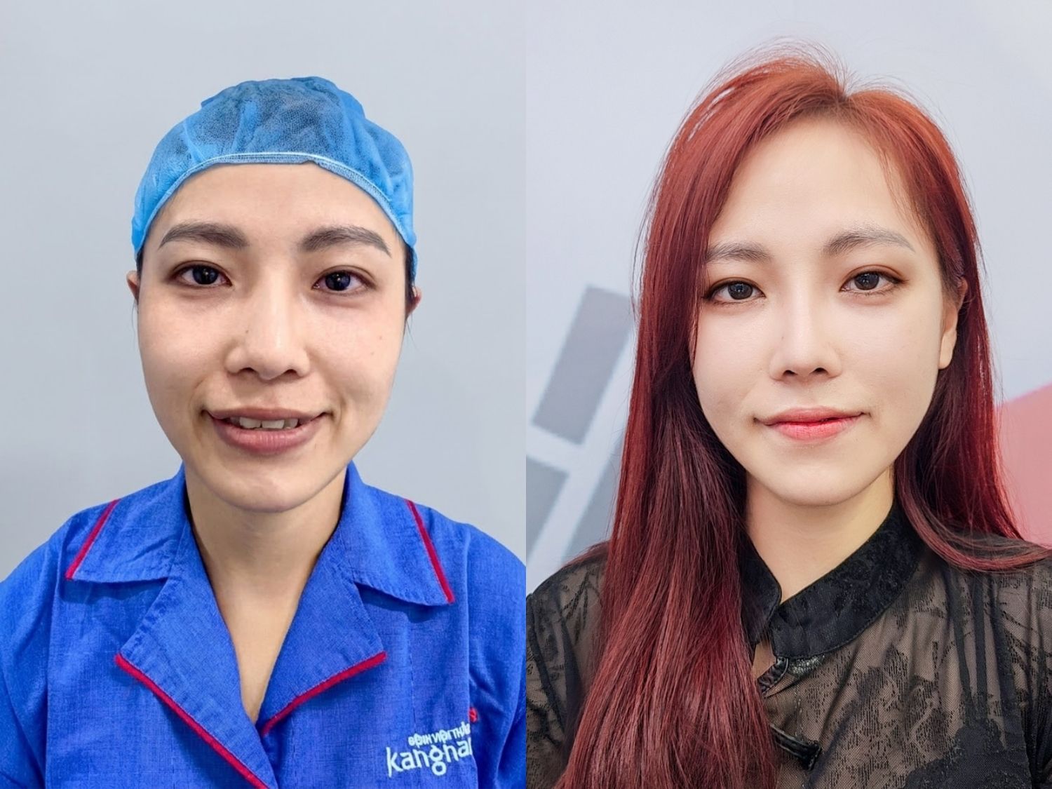 khách hàng giữ biểu cảm tự nhiên sau hạ gò má tại kangnam