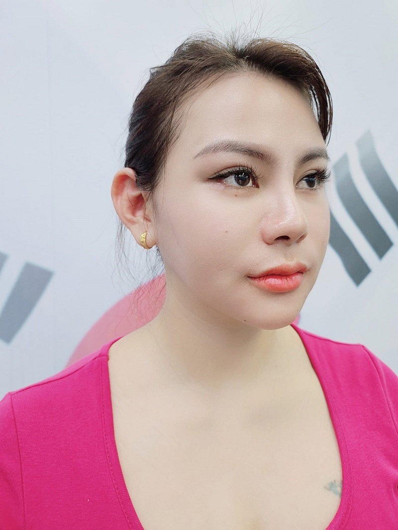 Khách hàng hạ gò má tại Kangnam hồi phục sau 7 ngày giảm sưng rõ rệt và tan bầm tím.