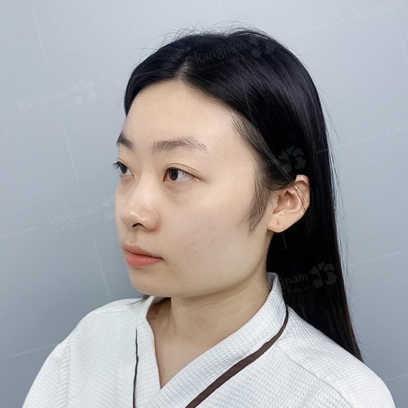 Góc hàm to bạnh, khiến khuôn mặt thô