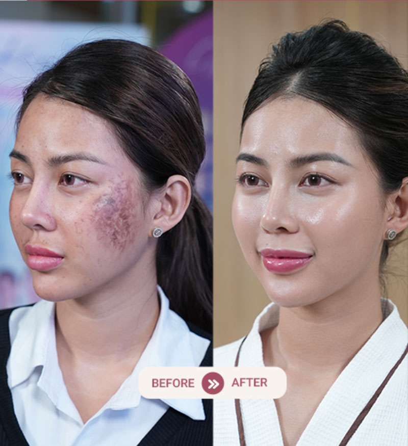 Điều trị tình trạng nám, tàn nhang hiệu quả cao