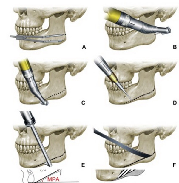 Sơ đồ giải phẫu xương mặt người phân biệt vị trí xương hàm dưới và xương gò má trong phẫu thuật chỉnh hình.