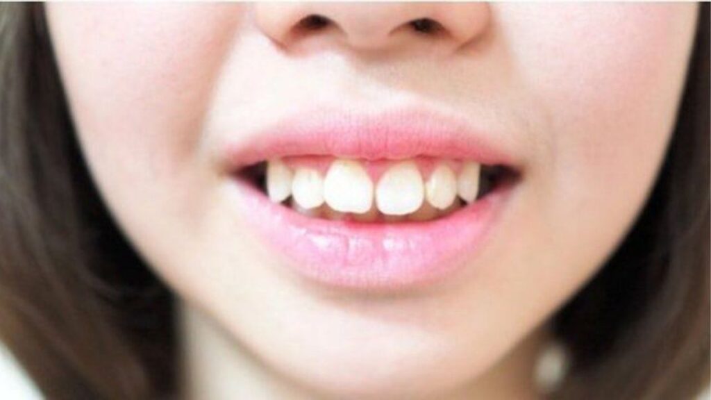 Hô nên niềng răng hay mổ hàm? 6 tiêu chí để chọn đúng phương pháp