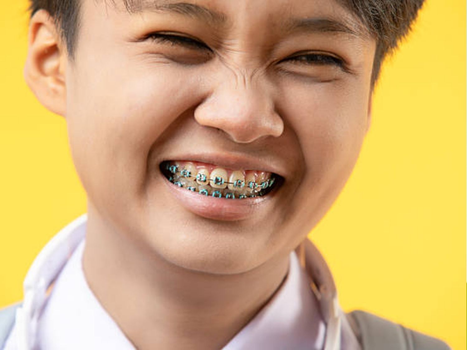 Niềng răng khắc phục tình trạng hô do răng chìa