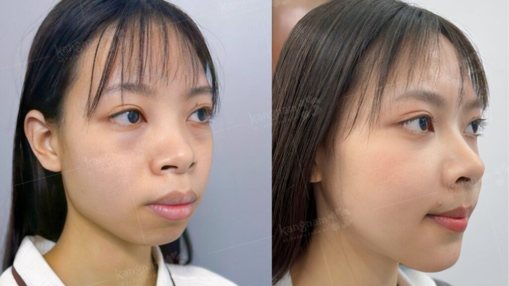 Hô xương có niềng được không? Giải đáp từ bác sĩ chuyên khoa Răng Hàm Mặt